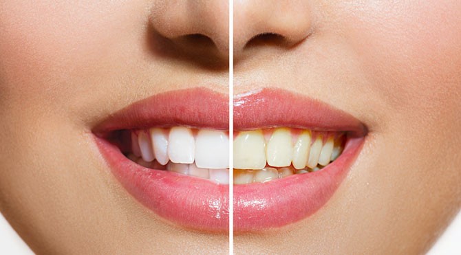Beyaz dişler neden daha sağlıklı değil?