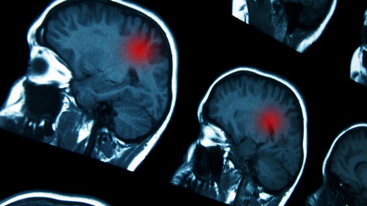 Beyin kanserleri neden gittikçe artıyor?