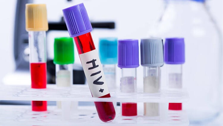 19 yıl sonra ilk kez yeni bir HIV virüsü keşfedildi