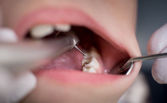 Çürük diş kalp enfeksiyonuna neden oluyor