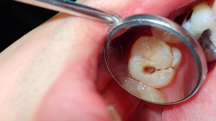 Korona virüs diş kaybına neden olur mu?