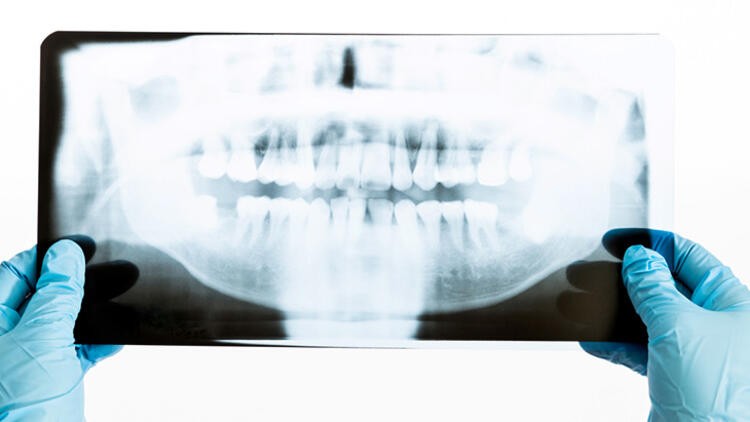 Korona virüs diş kaybına neden olur mu?
