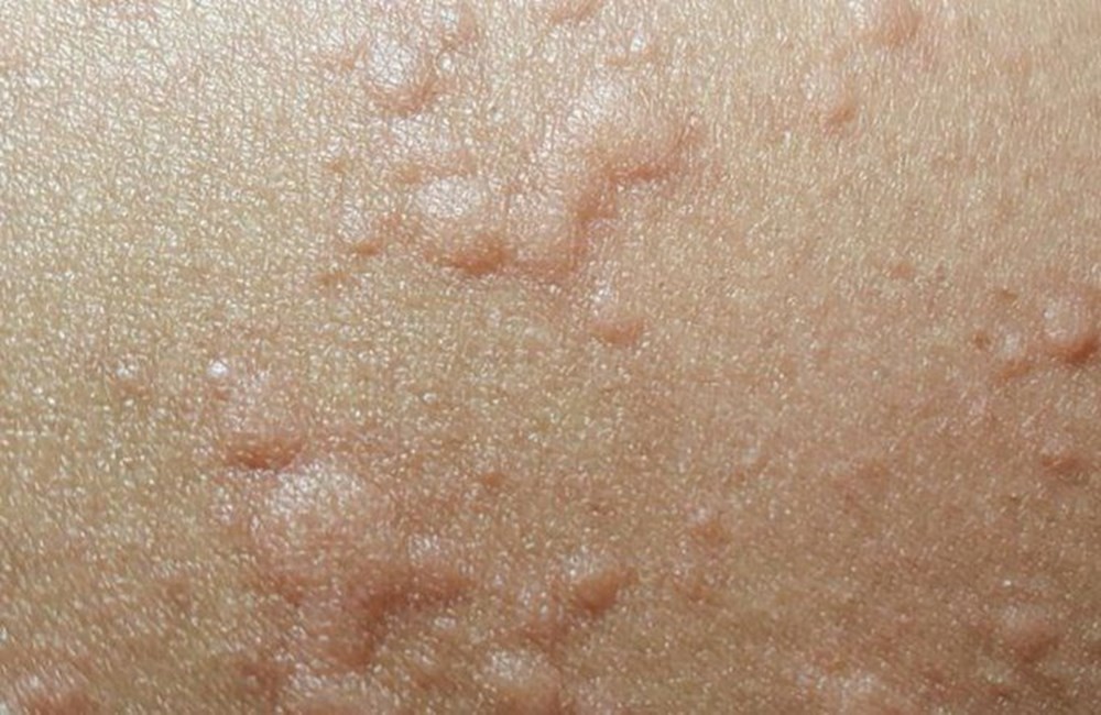 Korona virüs nedeniyle cildinizde meydana gelebilecek değişiklikler