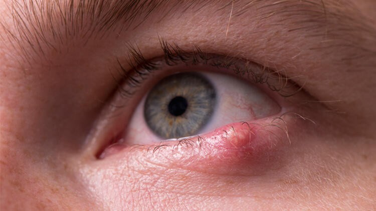Korona virüs gözlerde bu belirtileri veriyor