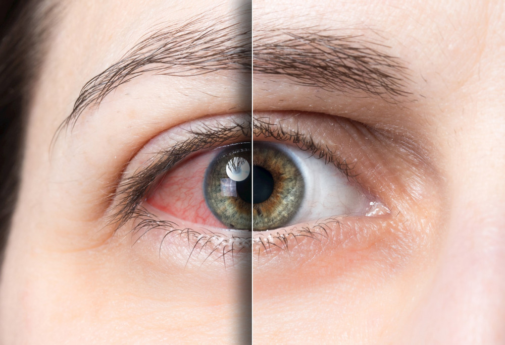 Kovid-19'in etkilediği bir organ daha! Gözümüzü nasıl koruyabiliriz?