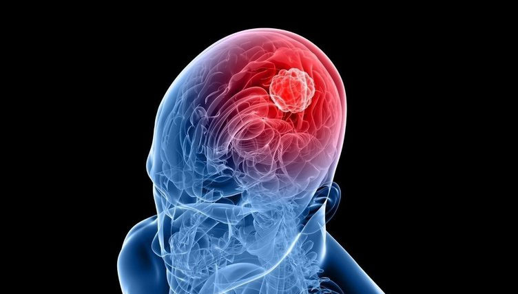 Beyin tümörü nasıl sinyal veriyor? İşte kritik belirtiler...
