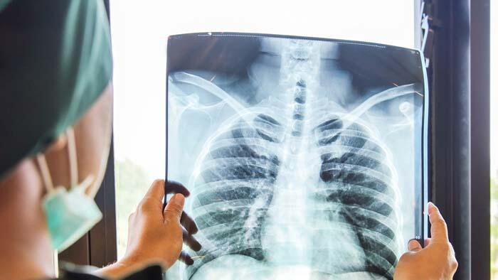 Gizli akciğer kanseri vakaları pandemide 5 kat arttı!