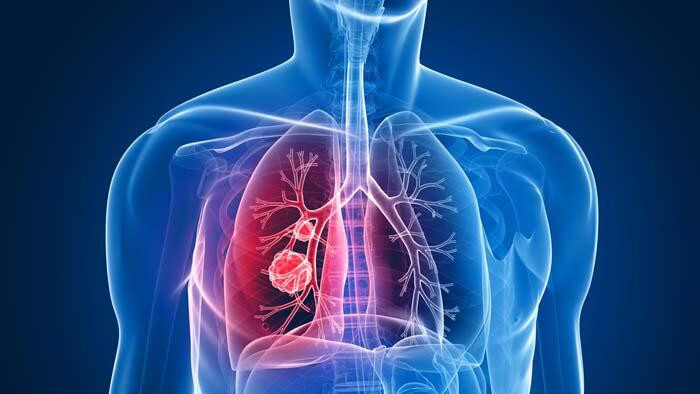 Gizli akciğer kanseri vakaları pandemide 5 kat arttı!