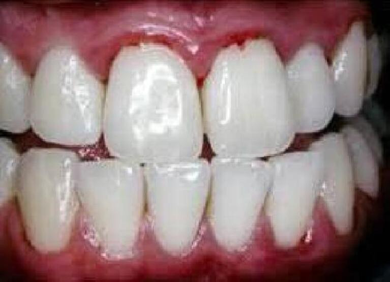 Kovid-19 tüm vücudu etkiliyor: En çok şikayet ise 'diş sıkma'