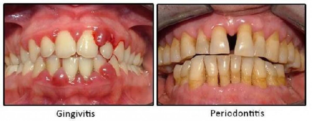 Kovid-19 tüm vücudu etkiliyor: En çok şikayet ise 'diş sıkma'
