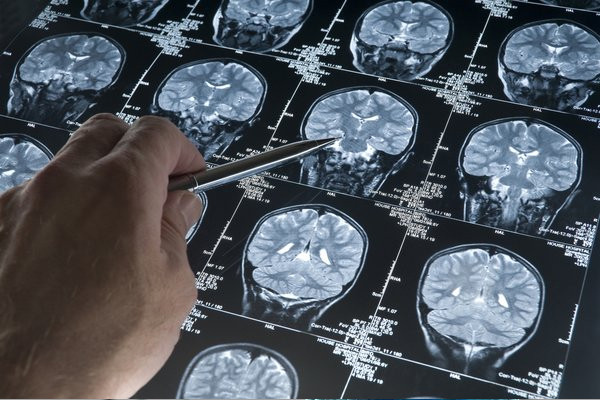 Uzmanlar uyardı: Bu alışkanlık Alzheimer'a neden oluyor!