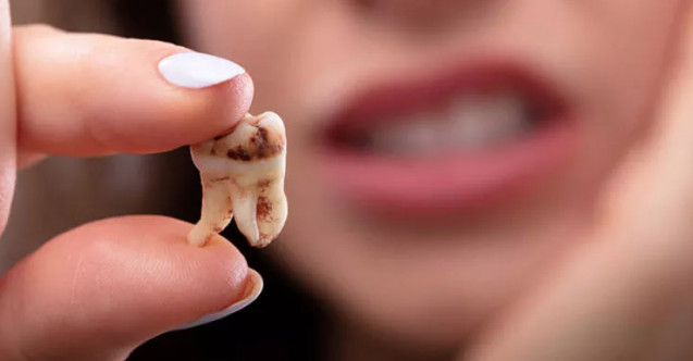 Çürük diş ağrısına ne iyi gelir?