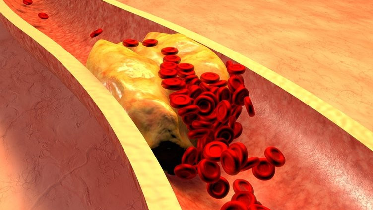 Bu hisse dikkat edin: Kolesterolün işareti olabilir!
