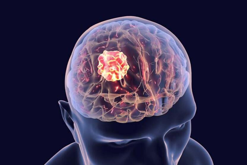 Bu işaretler ihmale gelmez: Beyin tümörünün 10 önemli belirtisi...