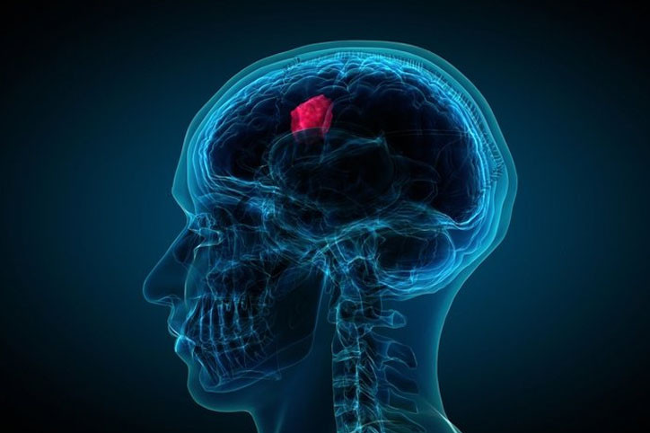 Bu basit ağrı beyin tümörü belirtisi!