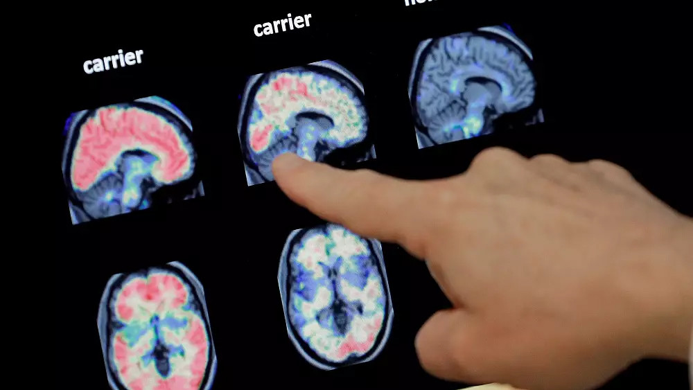 Etkisi yıllar sonra ortaya çıkıyor: Kovid beyni nasıl etkiliyor?