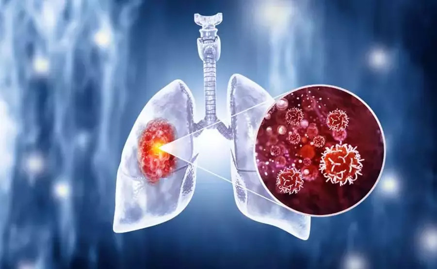 O kişilerde risk 30 kat daha fazla: İşte akciğer kanserinin belirtileri