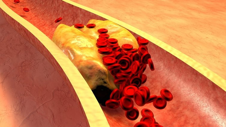 Yüksek kolesterolün en belirgin işareti gözlerde ortaya çıkıyor!