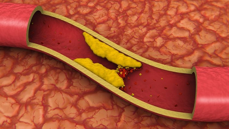 Yüksek kolesterolün en belirgin işareti gözlerde ortaya çıkıyor!