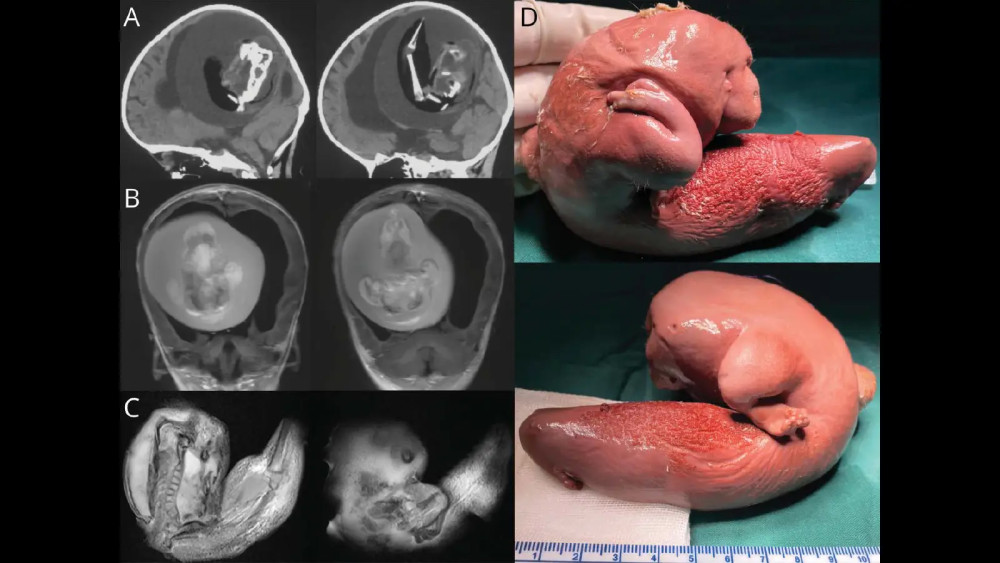 1 yaşındaki kız çocuğunun beyninden fetüs çıkarıldı!