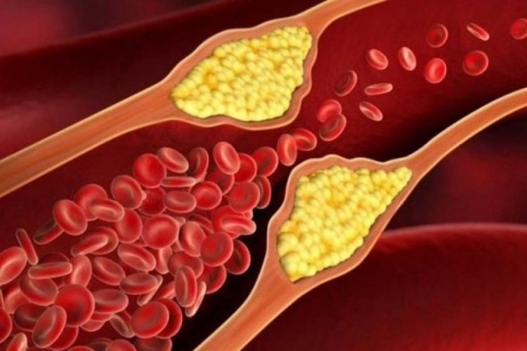 Araştırma: Kötü kolesterol demansa sebep oluyor!