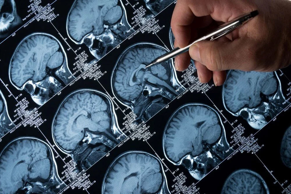 Çarpıcı araştırma: Alzheimer'ın ilk işareti gözlerde olabilir!