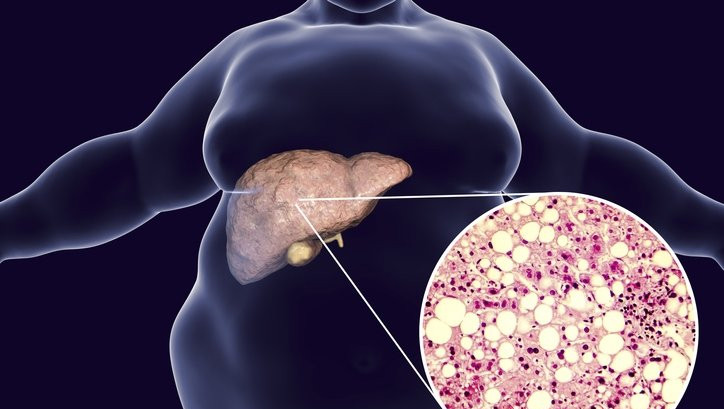 Karaciğerin tükendiğini belirten ilk belirti: Önemsenmezse hayati tehlike yaratıyor!