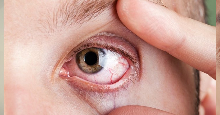 Eğer gözlerinizde bu semptom varsa dikkat: Damarlarınızın tıkandığının sinyali olabilir! 