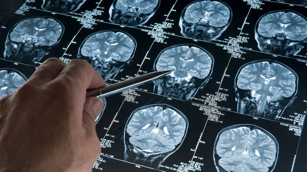 Uzmanlar duyurdu: Beynin yaşlanması tersine çevrilebilir mi?